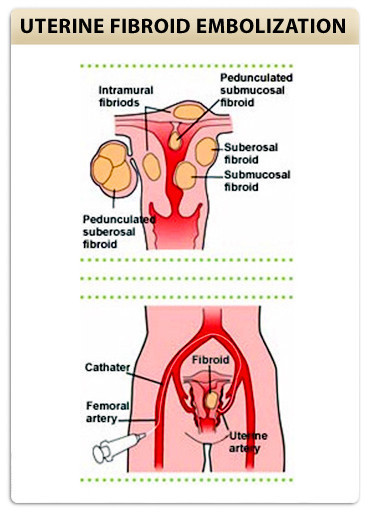 Uterine Artery Embolization procedure