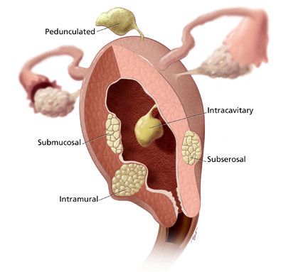 Myomectomy