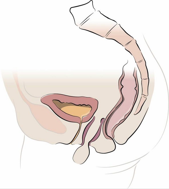 vaginal vault prolapse 