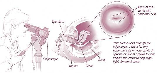 colposcopy procedure diagram