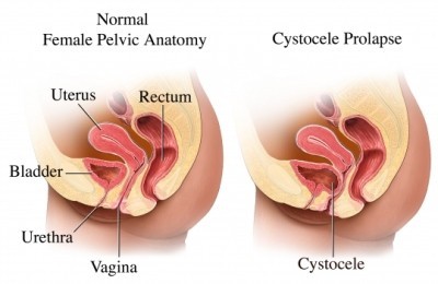 Cystocoele diagram