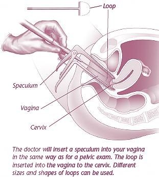 LEEP procedure diagram