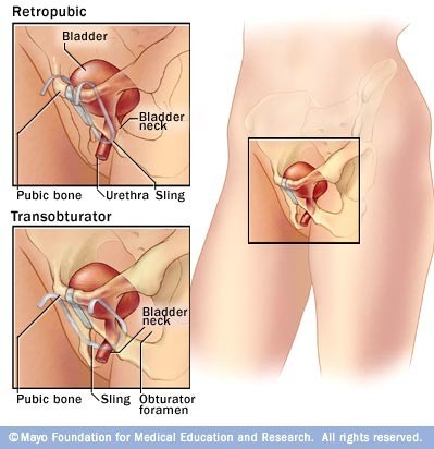Sling Procedure for Stress Incontinence