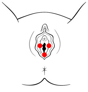 Generalized Vulvodynia diagram