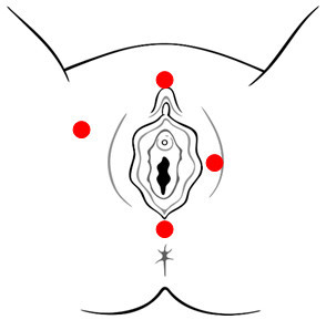 Generalized Vulvodynia