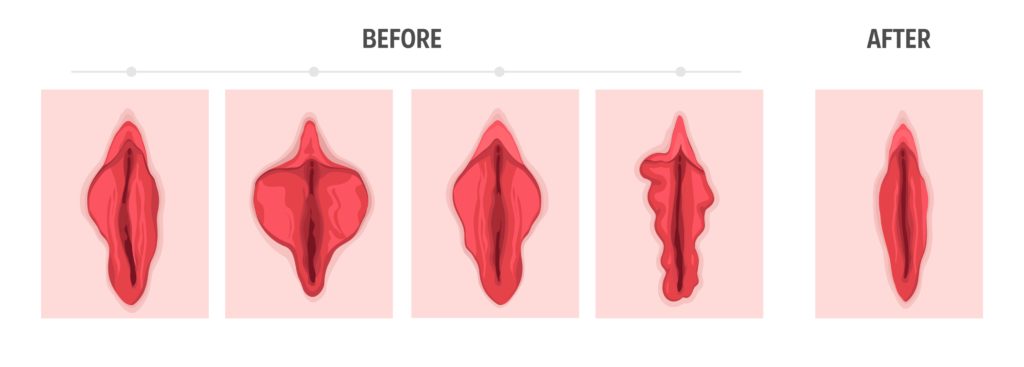 Vaginal Bleaching Los Ã¡Ngeles